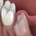 Featured image for 7 Signs You Need Your Wisdom Teeth Removed