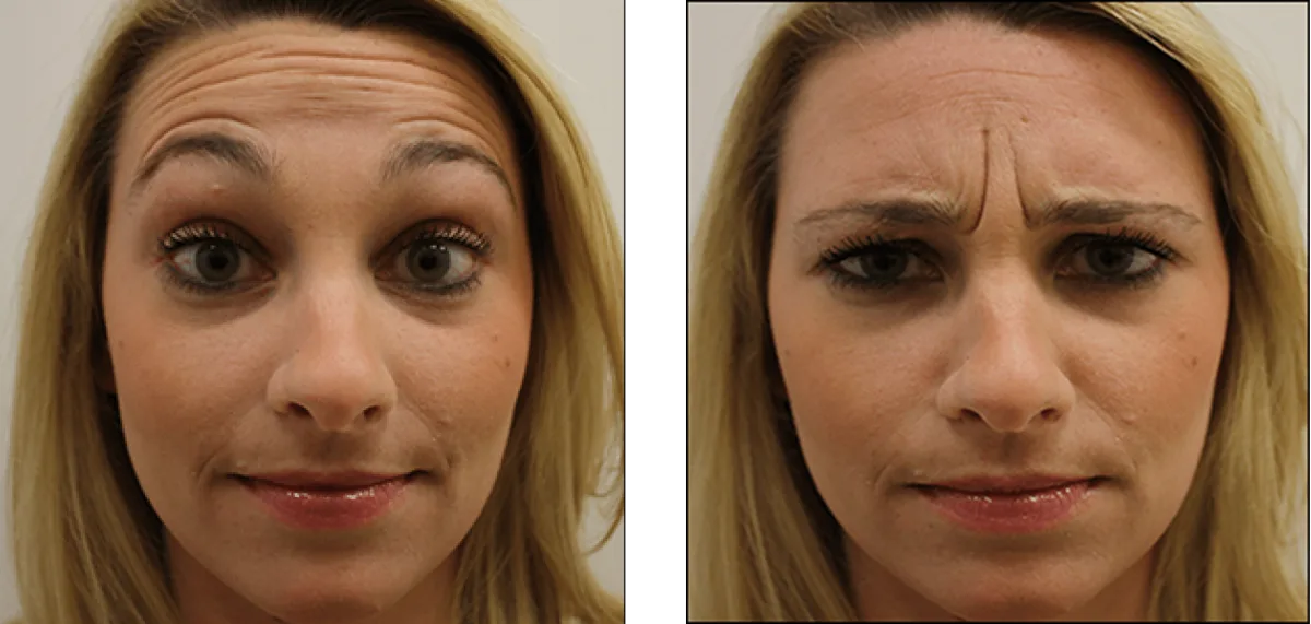 Anatomical mapping of facial mimic muscles for targeted cosmetic Botox injections