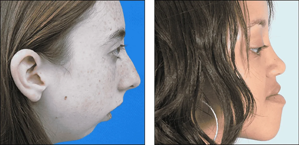 Post-surgical chin augmentation profile showing improved neck angle and jawline definition
