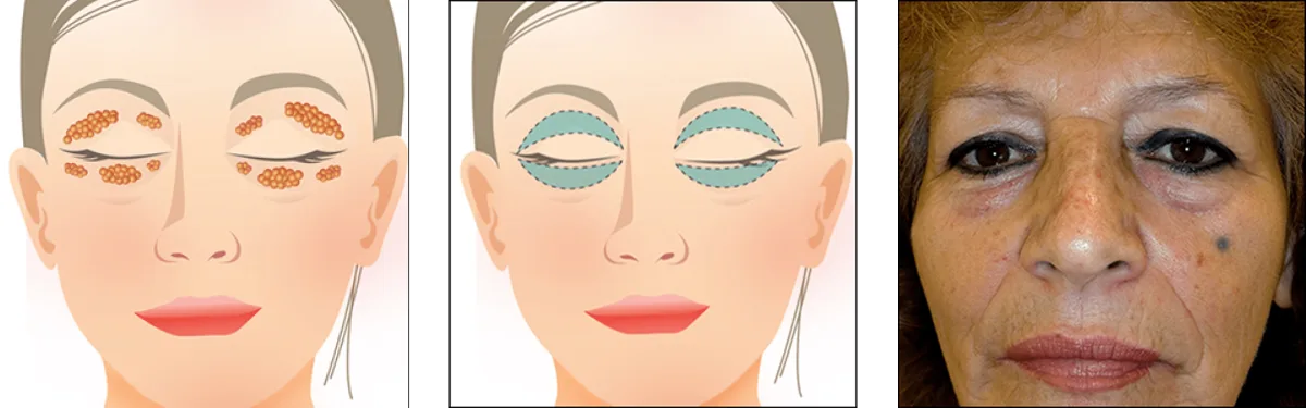 Blepharoplasty diagram showing upper eyelid skin excision and lower eyelid fat transposition
